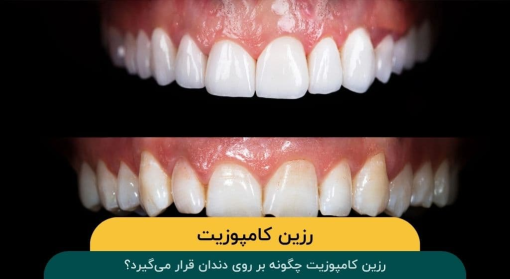 رزین-کامپوزیت-چگونه-بر-روی-دندان-قرار-می-گیرد